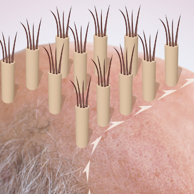 hair graft placement the final step in hair transplantation