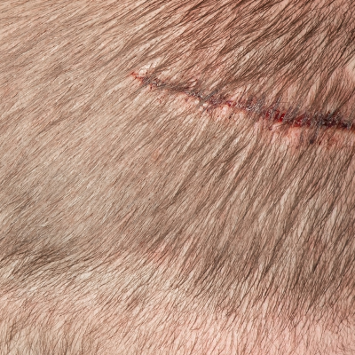 hair restoration in the scarred scalp