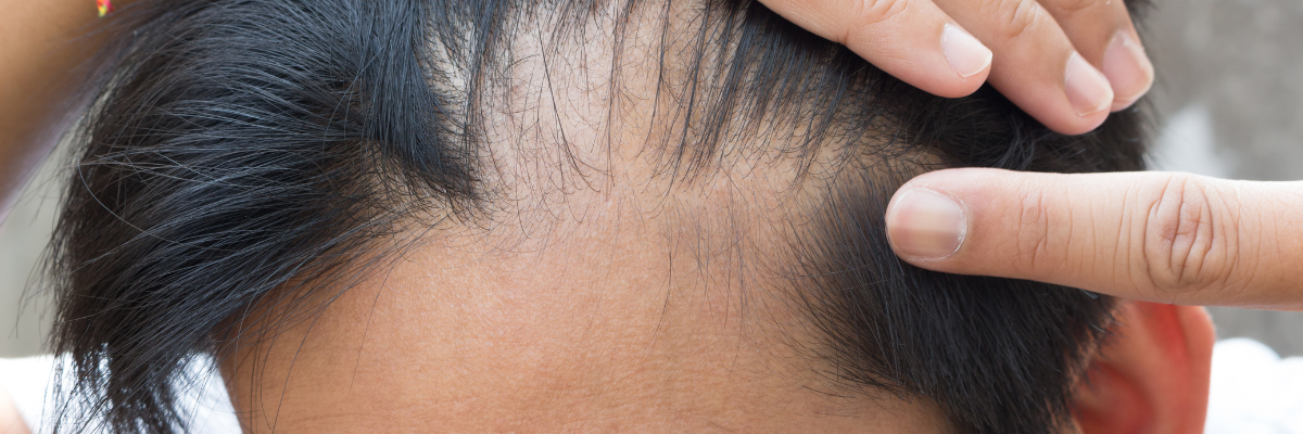 ishrs male pattern hair loss online survey