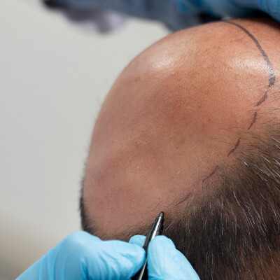 FUE recipient area outline