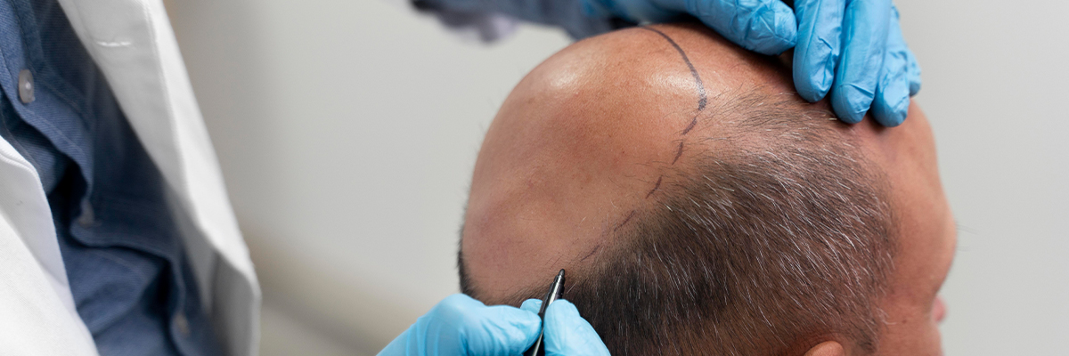 FUE recipient area outline
