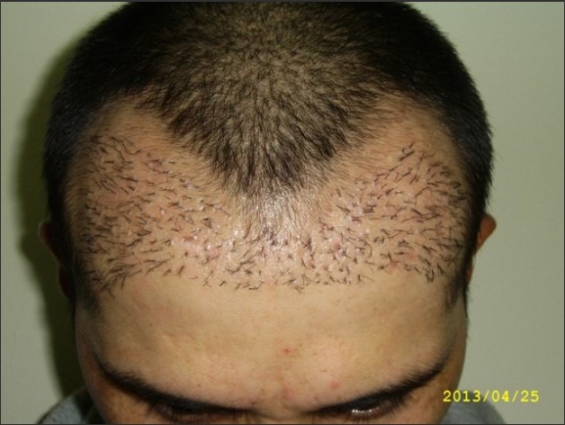 Unnaturally low hairline of a male patient after a transplant.