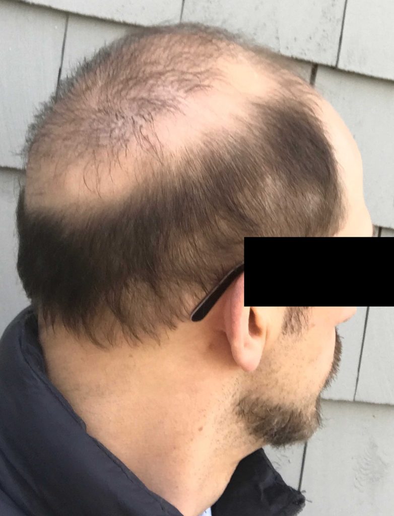 Unnatural hair in the crown of a male patient