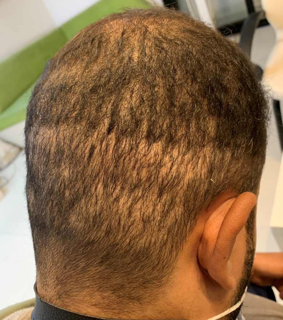 Over-harvested donor area after FUE in a male patient