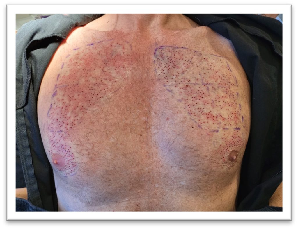 Chest hair of a male patient used for a hair transplant using FUE