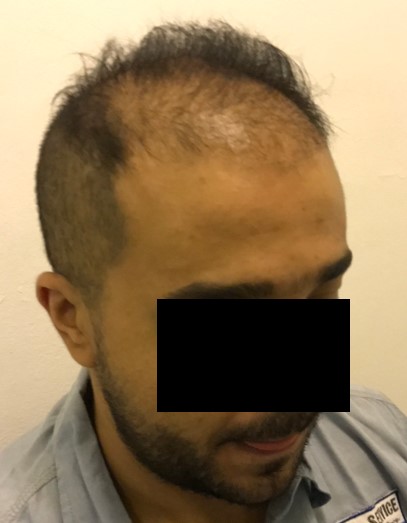 Low-density hair transplant of a male patient