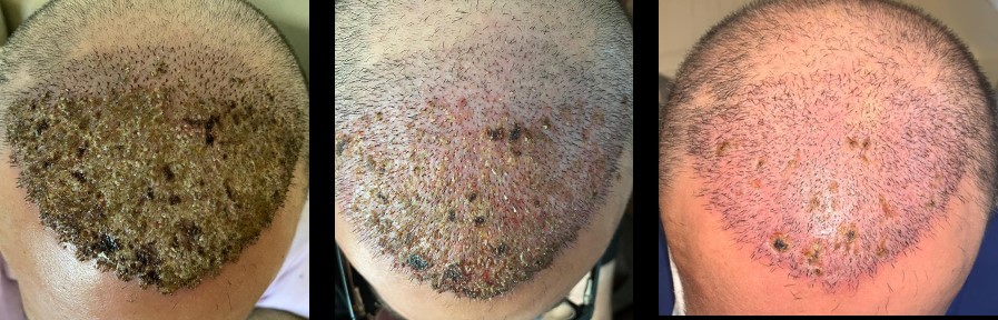 Scalp necrosis of a male patient due to poor surgical techniques