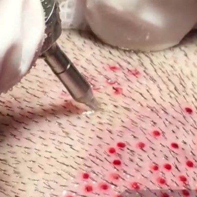 fue graft harvesting