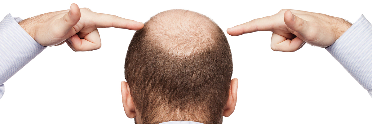 treatments for hair loss 1200x400