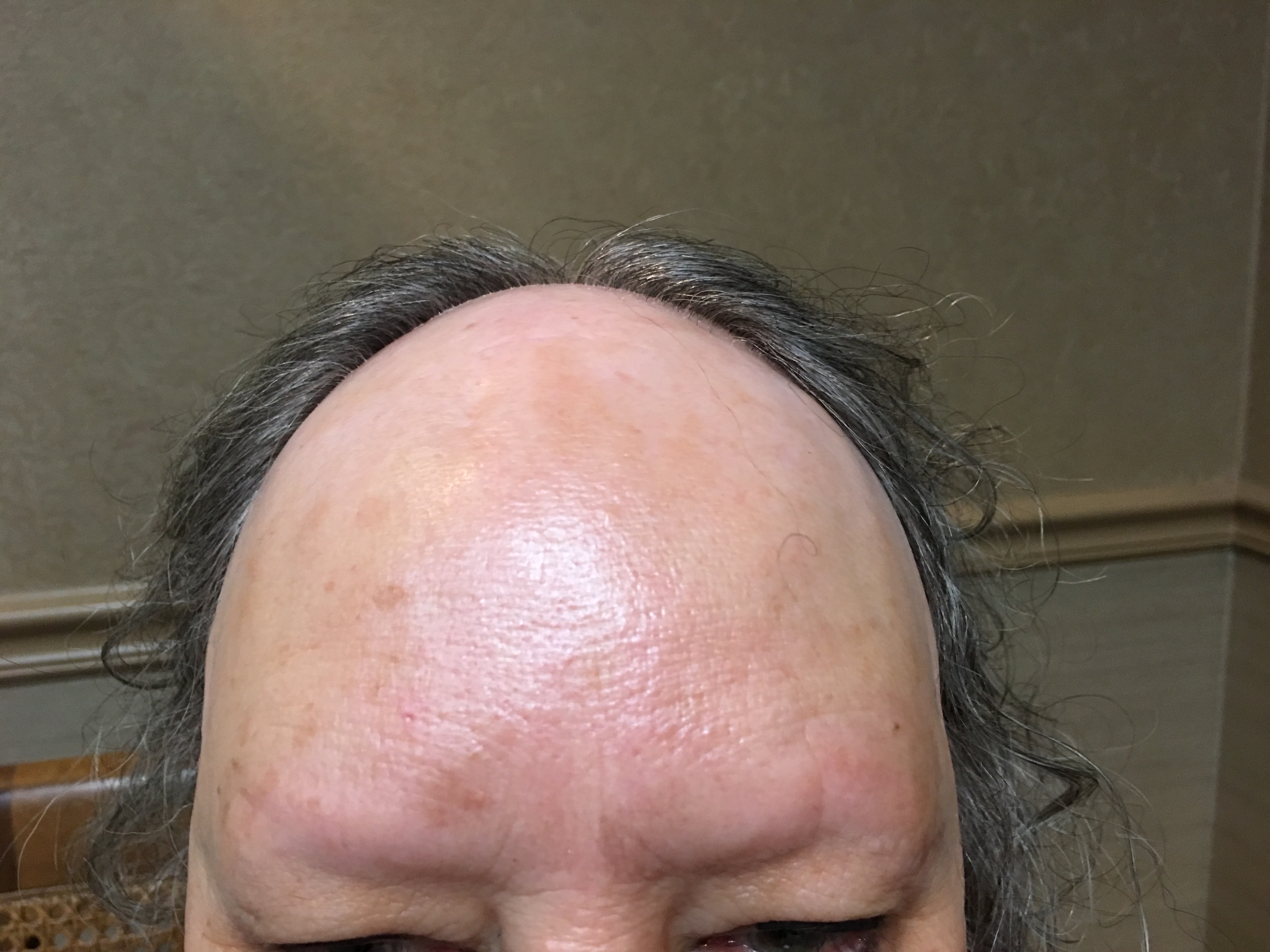 Uncover Hair Loss Causes & Solutions for Men & Women Here's How!