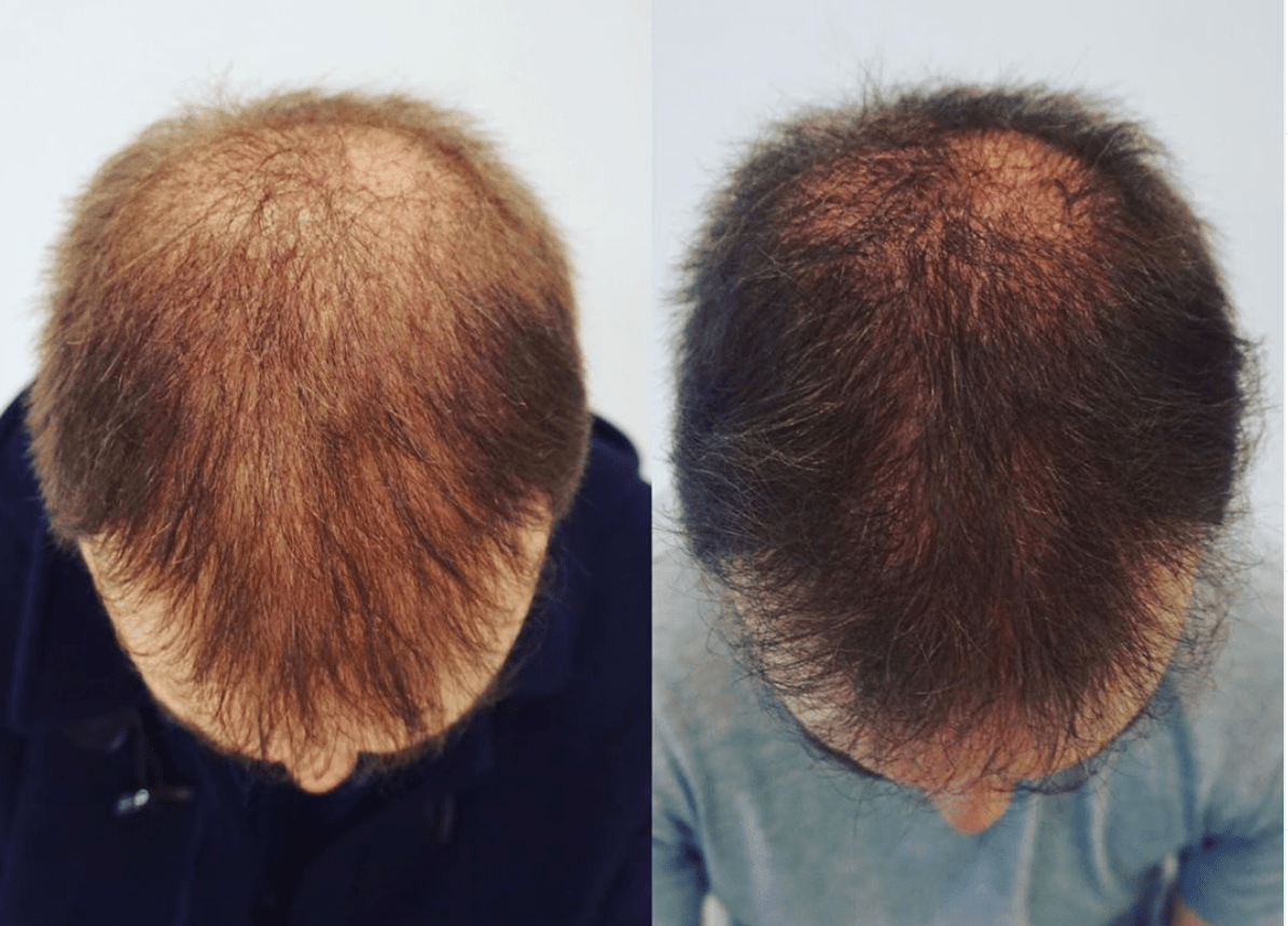 Discover Dr. Gorana Kuka Epstein's Journey into Regenerative Medicine for Hair Loss