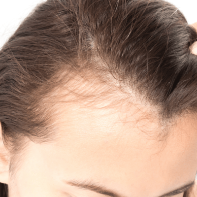 female hair loss