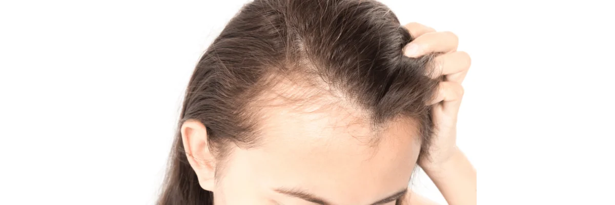 female hair loss