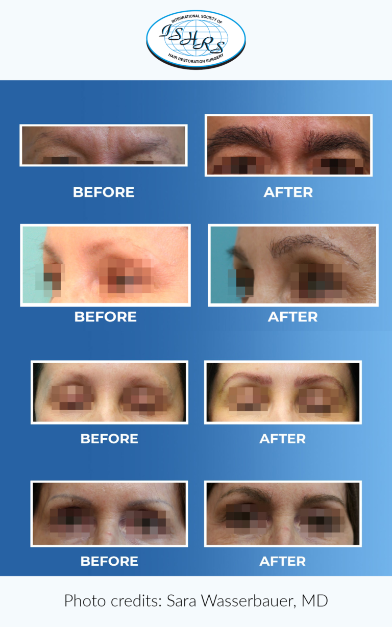 Body Hair Transplantation Permanent Solution for Fuller Hair