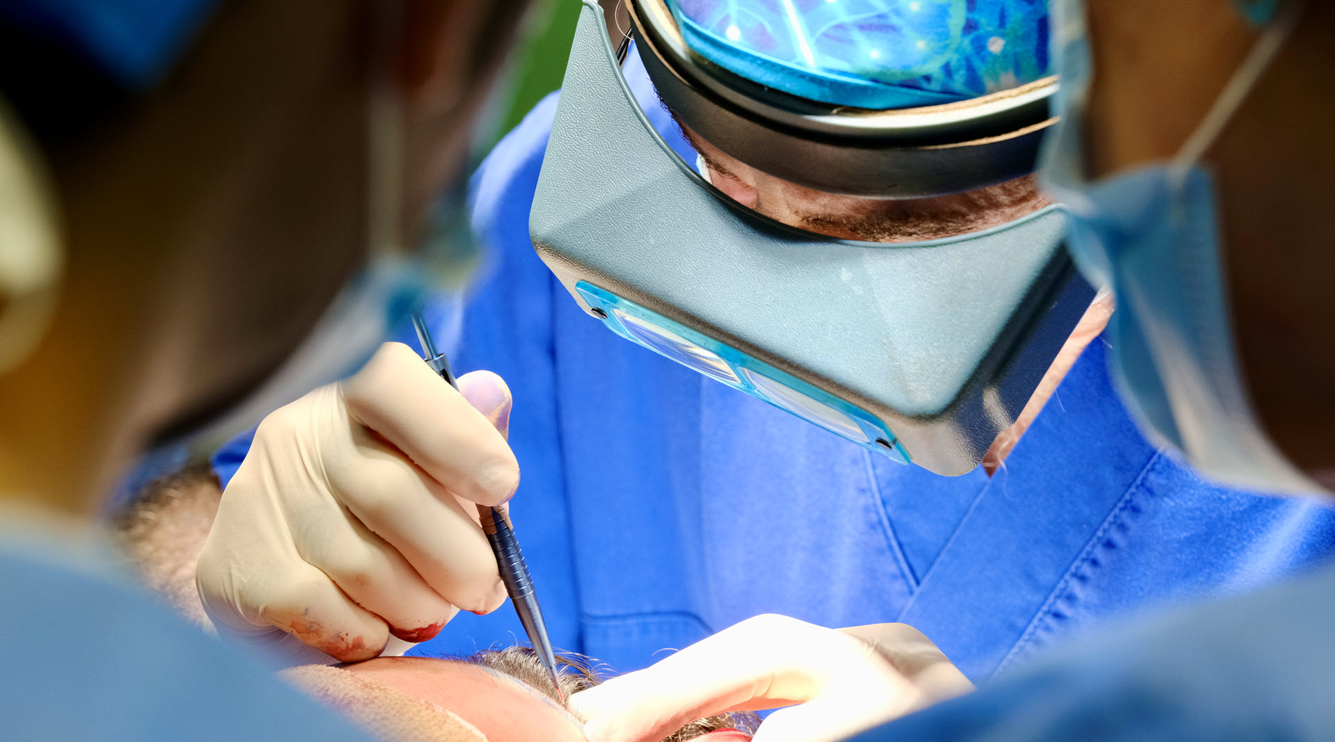 ishrs hair transplant repair day 2023