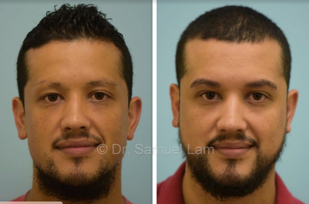 beard transplant before after results