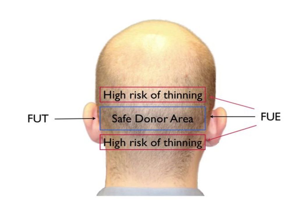 donor area assessment