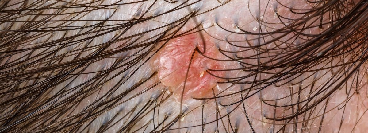 folliculitis