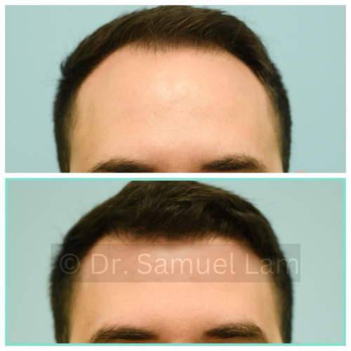 fue before and after front side