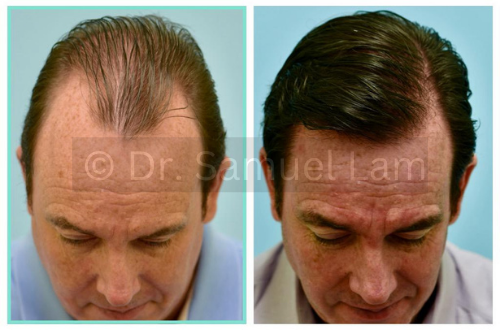 Top side: FUT before and after image