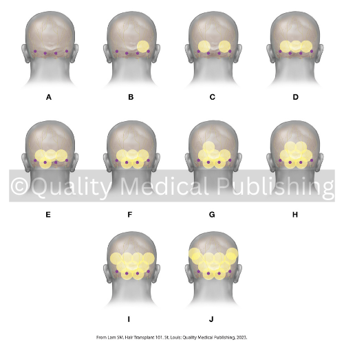 anesthesia administration in a hair transplant.