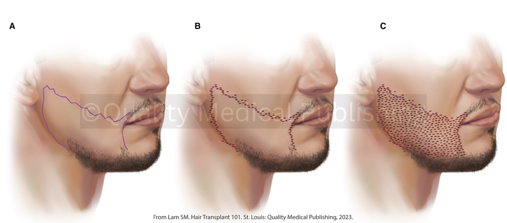 beard hair recipient sites