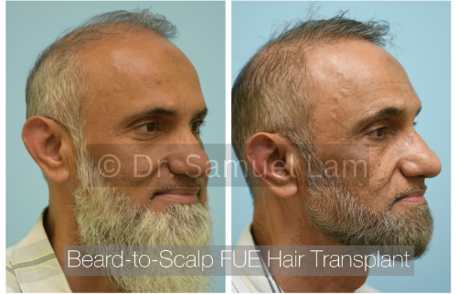 beard to scalp fue transplant (2)