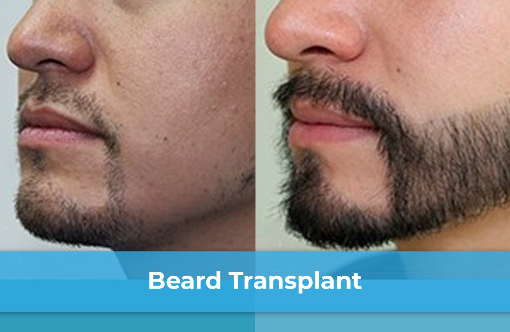 beard transplantation