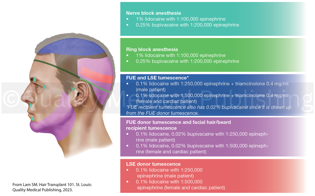 Anesthesia administration in FUE and FUT