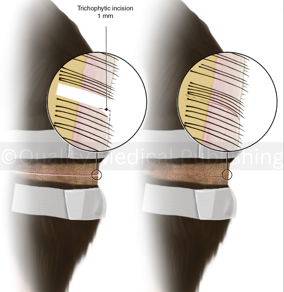 harvesting and closure of donor area