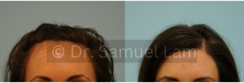 female patient with a natural high hairline