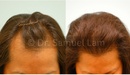 female with frontal hair loss