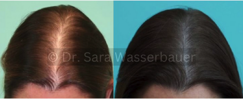 female low density hair using smp