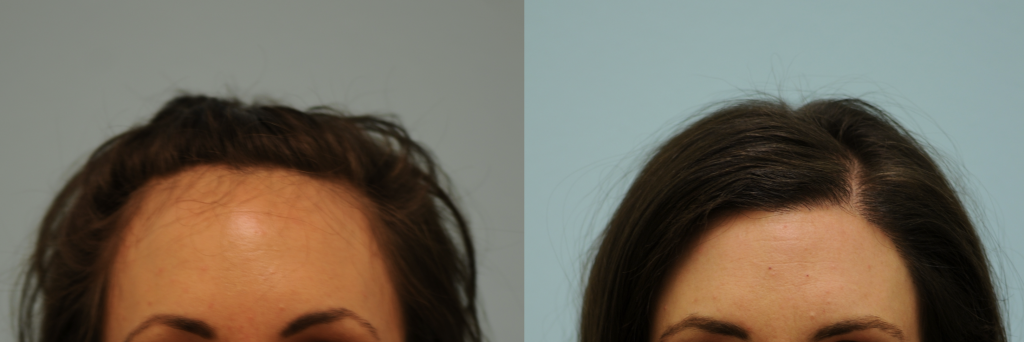 female patient with a natural high hairline