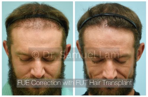 fue correction with fut transplant (2)