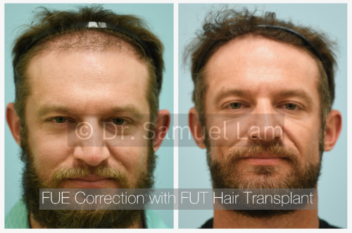 fue correction with fut transplant