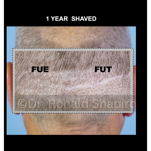 fue vs fut scars shaved