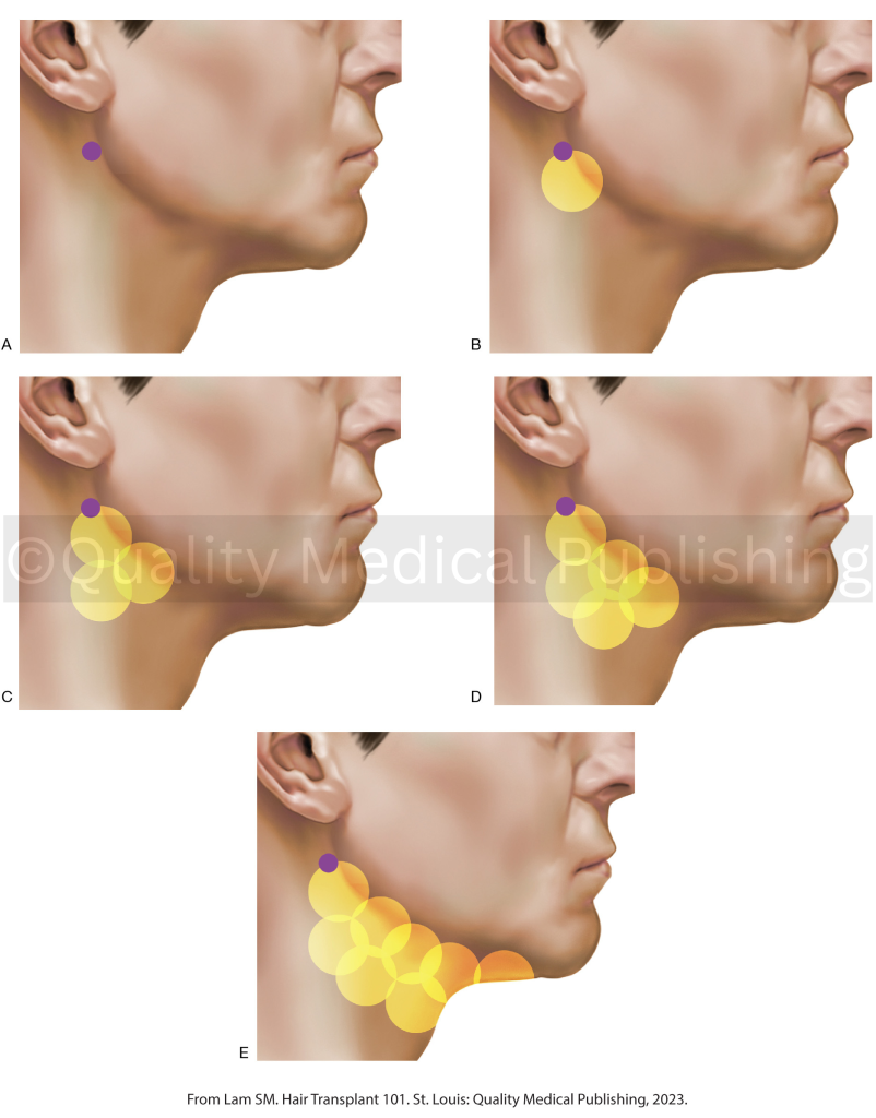 anesthesia administration in a beard transplant