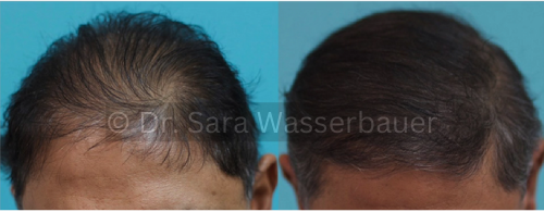 low density hair before and after smp