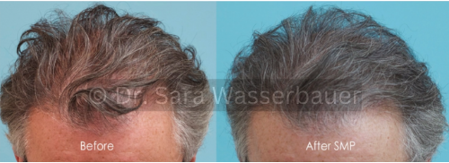 low density hair correction using smp
