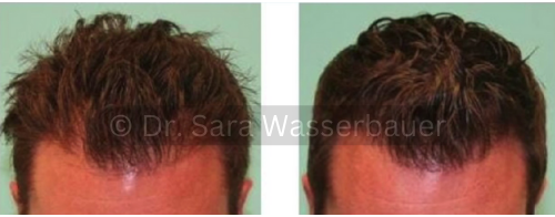 male low density hair correction by smp