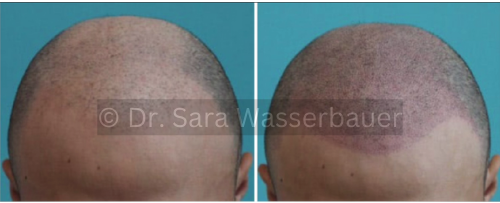 male shaved look before and after smp
