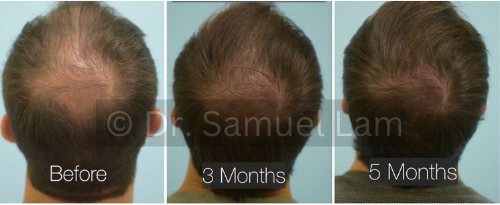 oral finasteride results in a male patient
