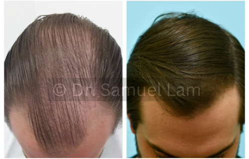 oral minoxidil results in a male patient