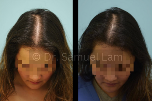 platelet rich plasma therapy injection results
