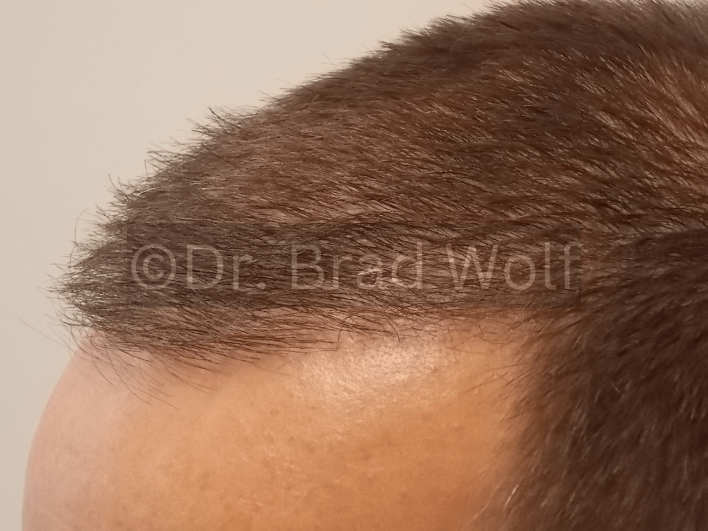 Transplant results after 6 months.