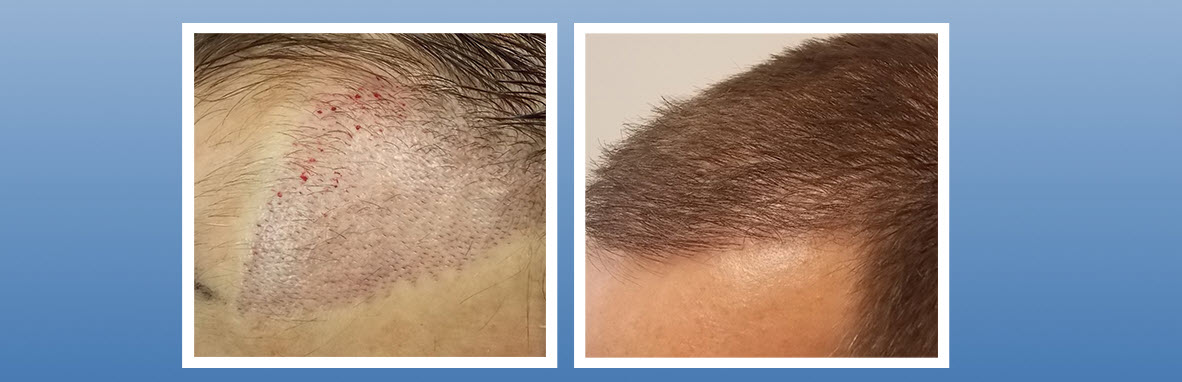 recipient area hair transplant