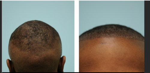 This African-American patient is shown one day after an FUE transplant with the harvested area on the left and the recipient area on the right side of the image.