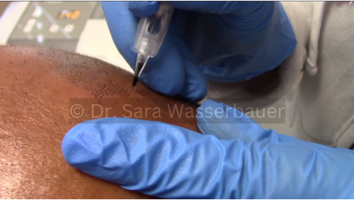 smp procedure