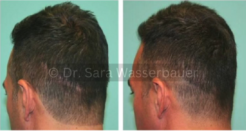 transplant scar correction before and after SMP